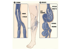 Disease of venous system-Shenzhen Xingyin Pharmaceutical Co., LTD